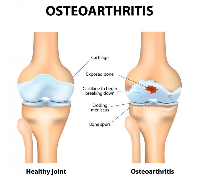 Diagram showing osteoarthritis of the knee jpg